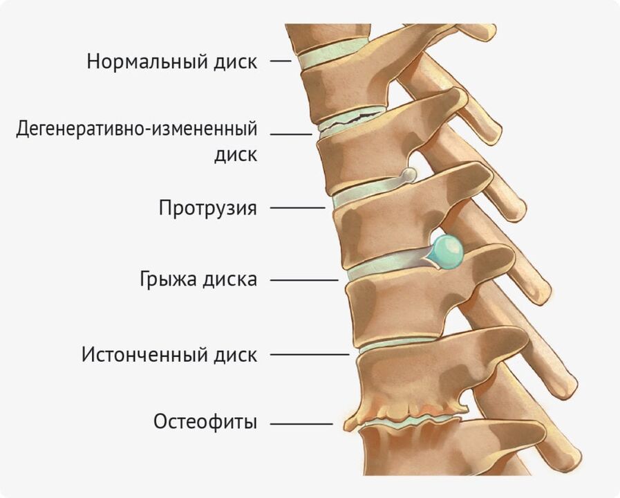Deformacije diskov za ledveno osteohondrozo