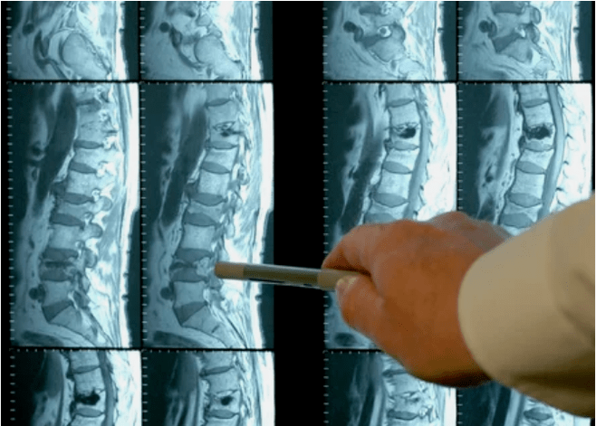 Sorte osteohondroze v hrbtenici