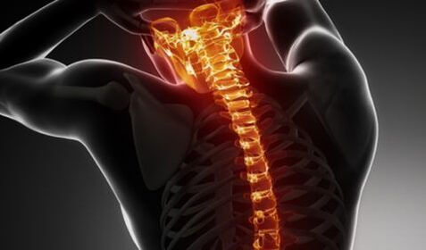 Osteohondroza celotne hrbtenice
