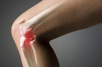 Arthroza kolenskega sklepa je lezija hrustančnega tkiva