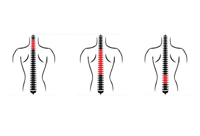 Kako se manifestira osteohondroza