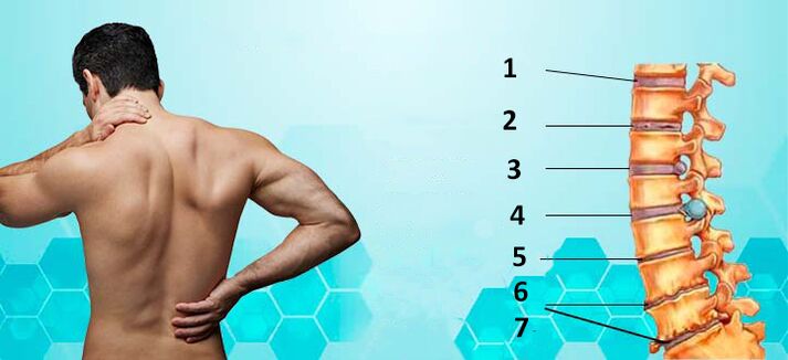 stopnje razvoja osteohondroze