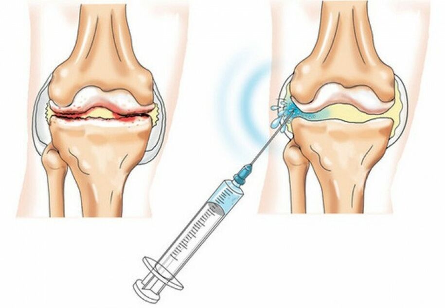 injekcija v kolenski sklep z artrozo