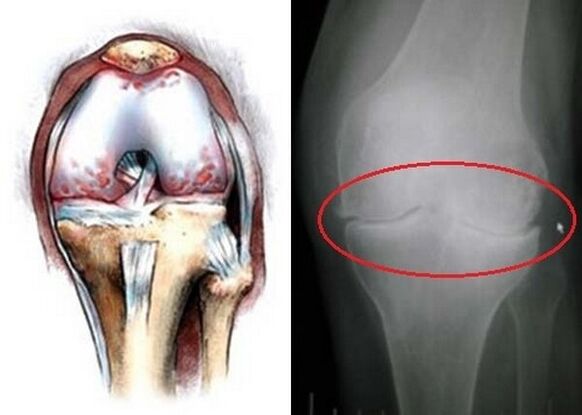 osteoartritis kolenskega sklepa