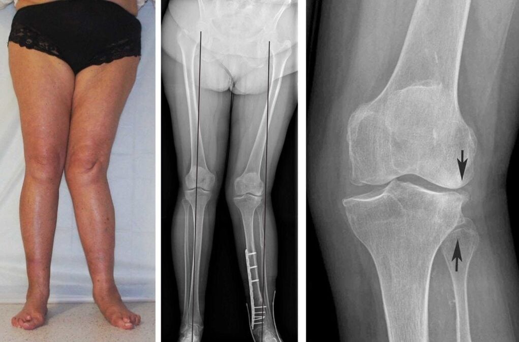 Napredovala artroza kolenskih sklepov je jasno vidna vizualno tudi brez rentgenskih žarkov