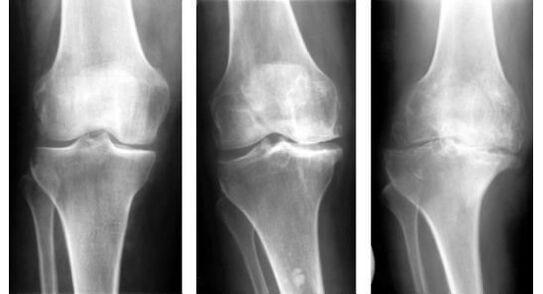 Obvezen diagnostični ukrep pri prepoznavanju artroze kolena je rentgen