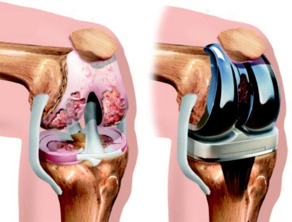 V primeru popolne poškodbe kolenskega sklepa zaradi artroze ga je mogoče obnoviti z endoprostetiko